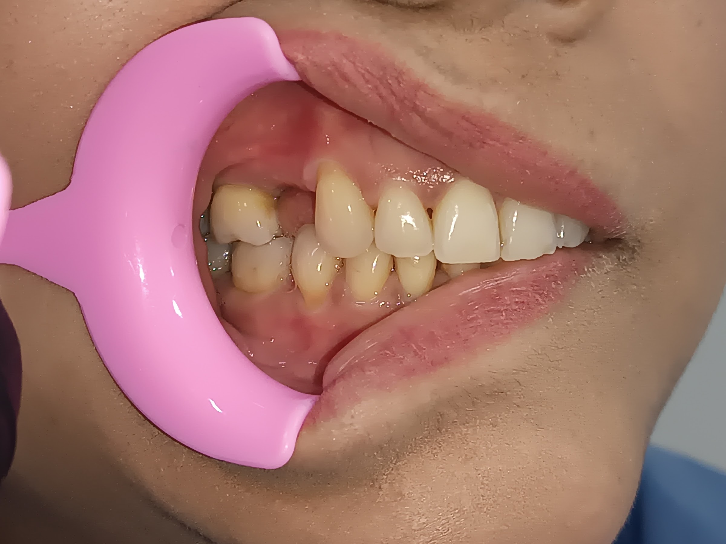 Paciente 1 - Estado Inicial