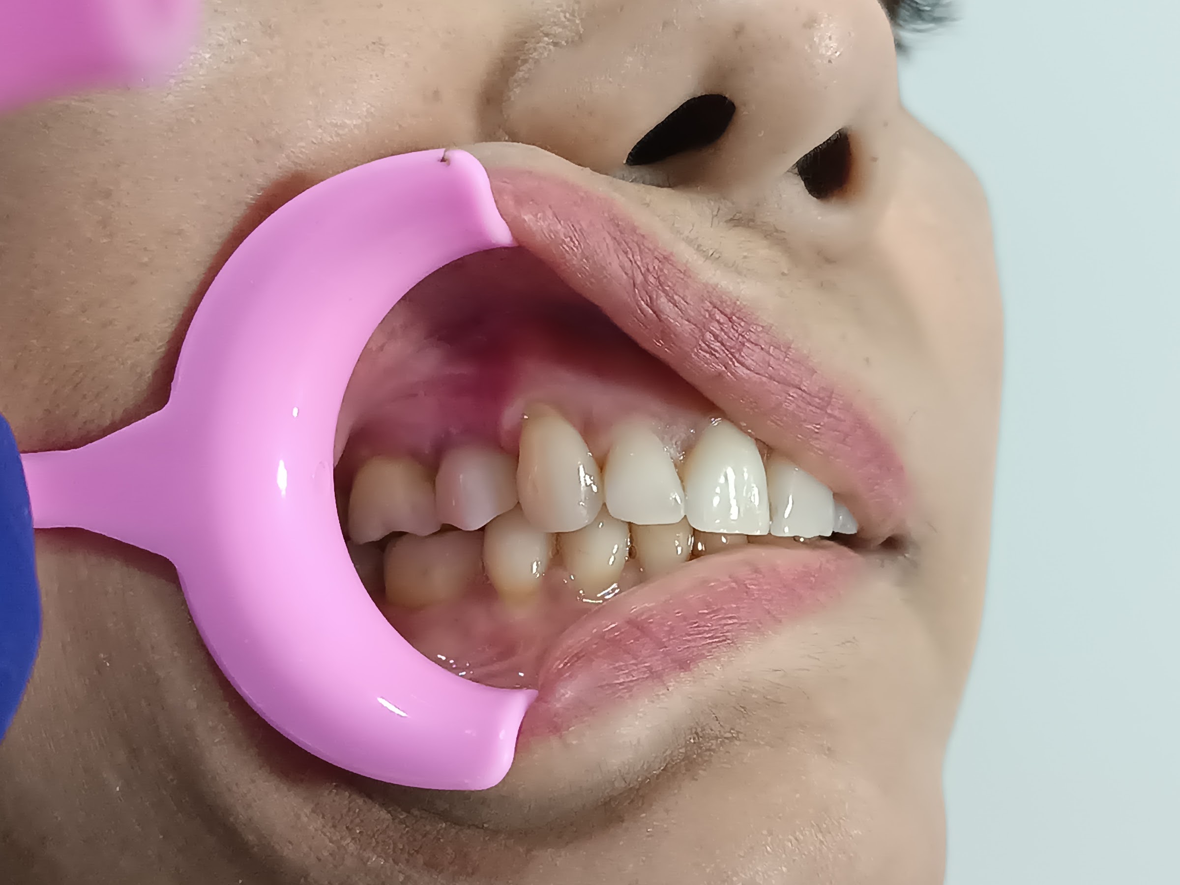 Paciente 1 - Resultados Finales