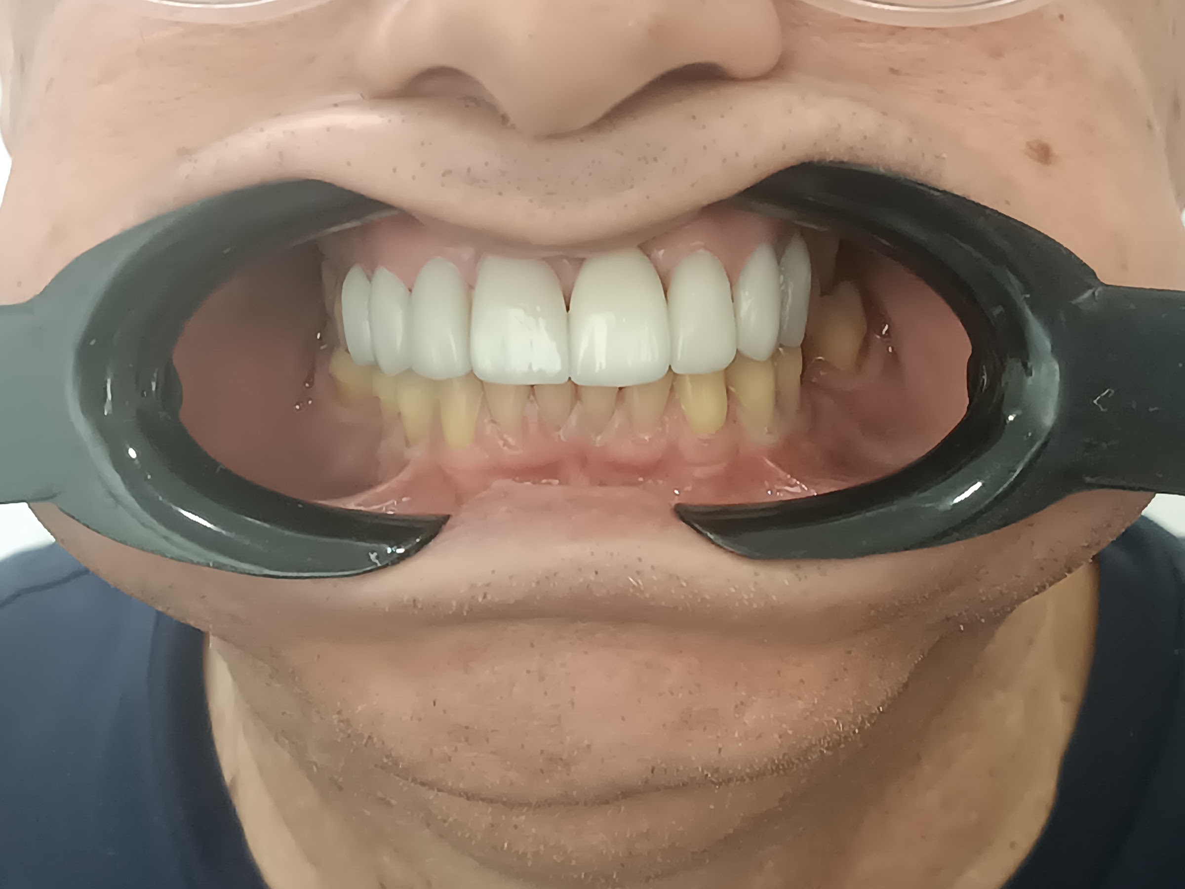 Paciente 2 - Resultados Finales